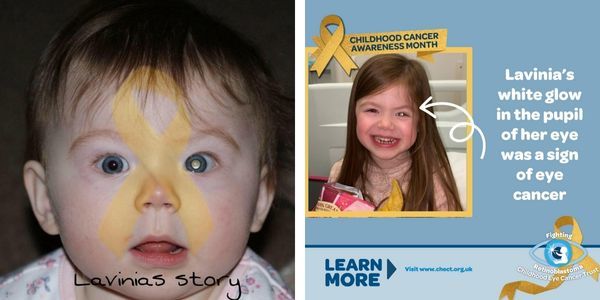 Retinoblastoma Awareness: Lavinia's Story