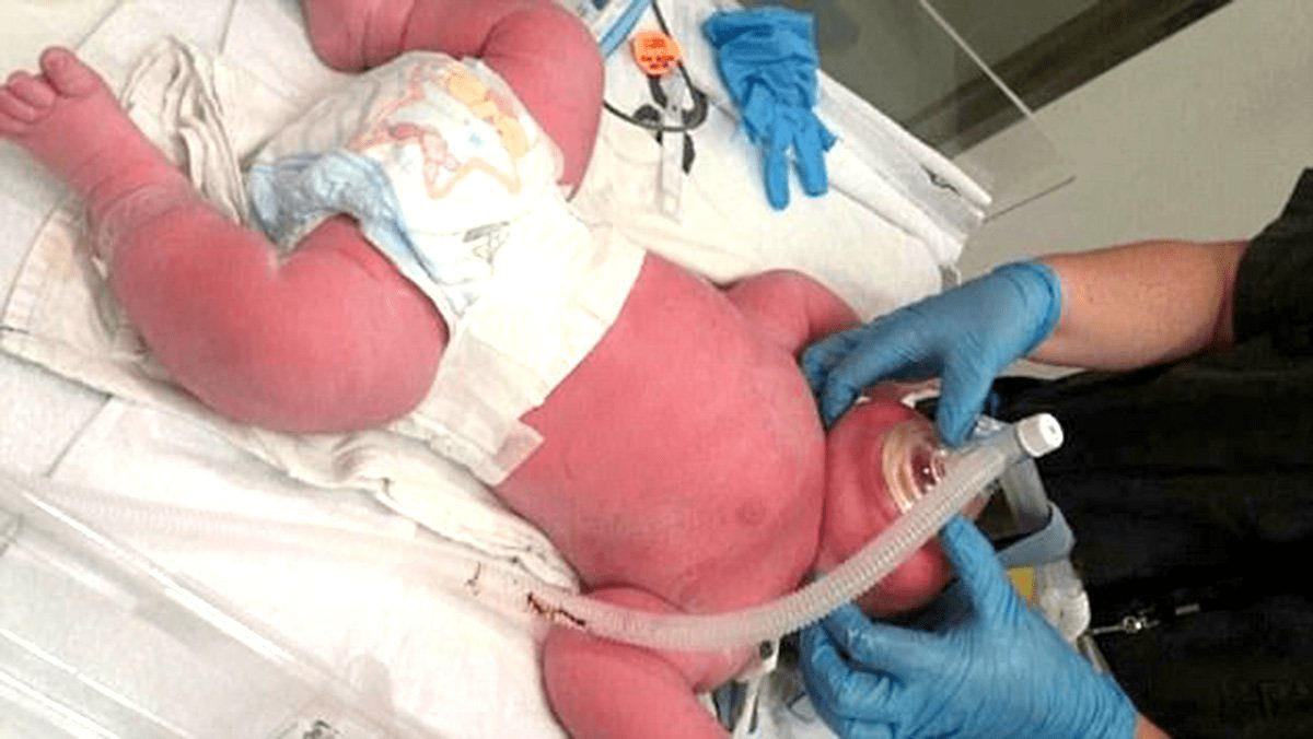 16lbs Baby Born In New Zealand